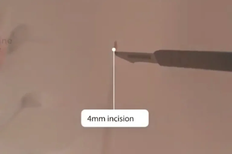 4mm incision used in Deuk Plasma Rhizotomy — smaller than a dime and requiring no stitches