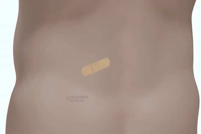 Small bandage after Deuk Plasma Rhizotomy, showing same-day outpatient recovery