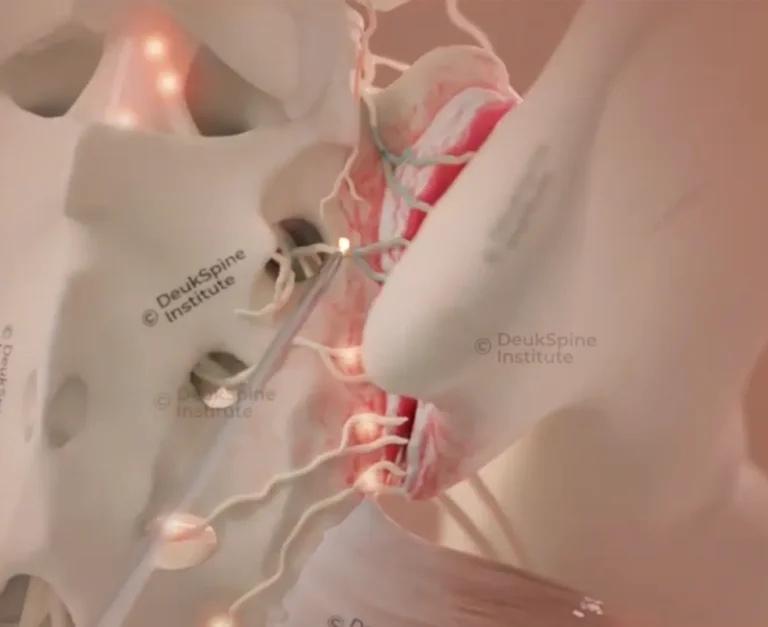 Animation still of Deuk Plasma Rhizotomy treating the sacroiliac (SI) joint