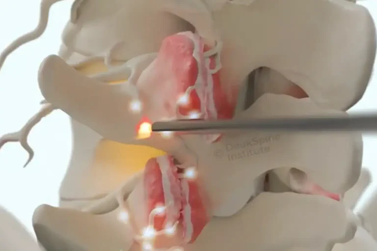 Deuk Plasma Rhizotomy wand targeting the pain nerves around an arthritic joint